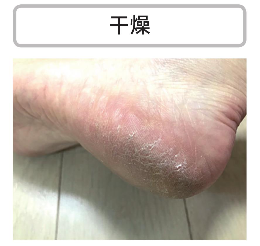 脚底的老茧怎么才能根治,老茧下的鸡眼