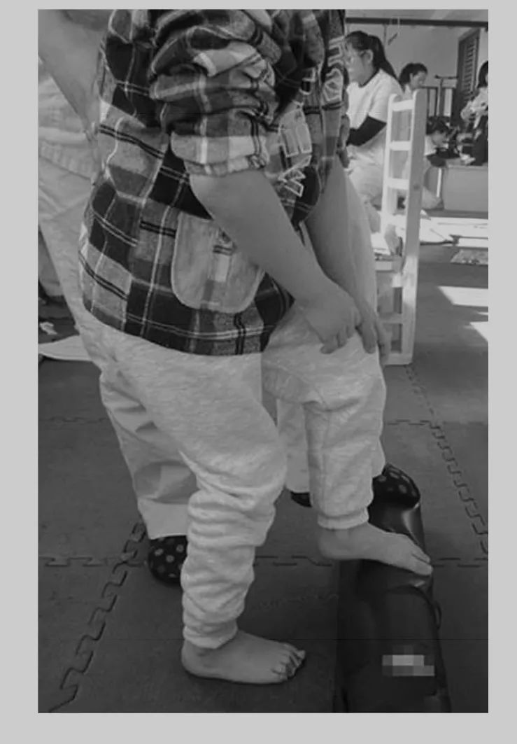 痉挛型脑瘫儿童下肢康复训练方法,小儿脑瘫尖足治疗方法