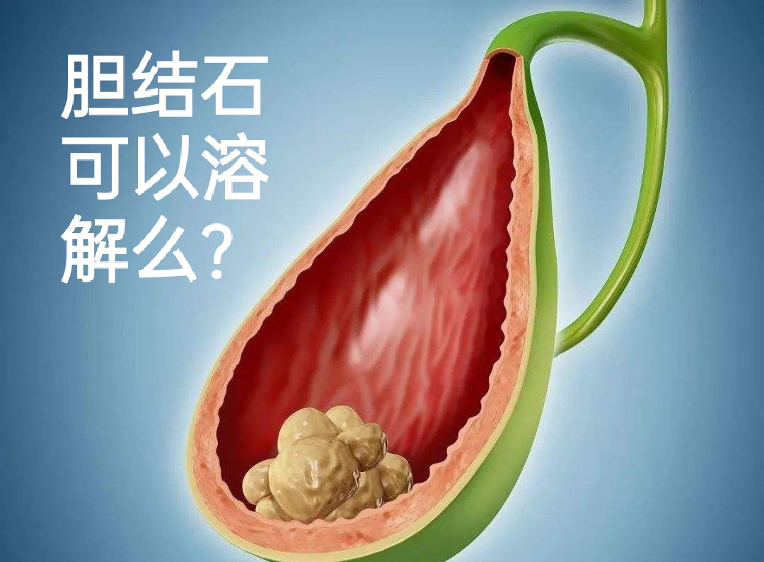 溶解胆结石的药有哪些,体检发现胆结石需要治疗吗