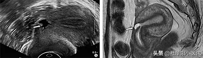 剖宫产疤痕超声图片,剖腹产子宫瘢痕超声表现