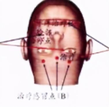 三穴位治疗感冒（杜建华）