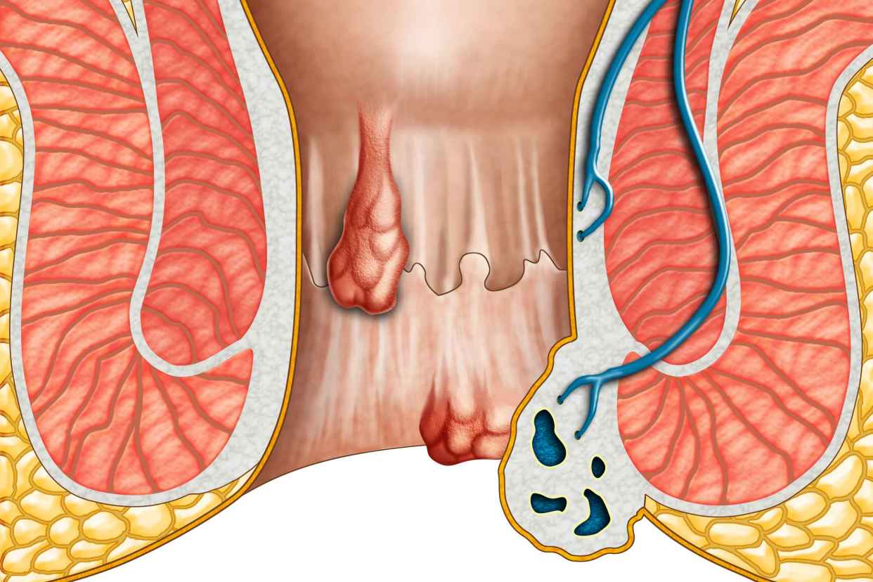 如何治疗内痔和外痔,如果得了内痔怎么治疗