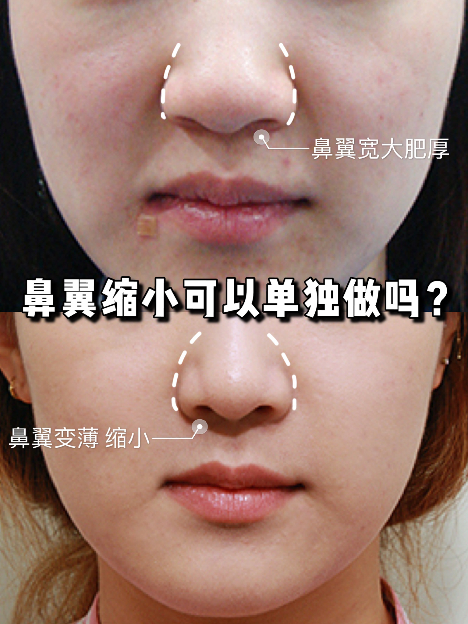 鼻翼缩小可以单独做吗,鼻翼缩小可以内切吗