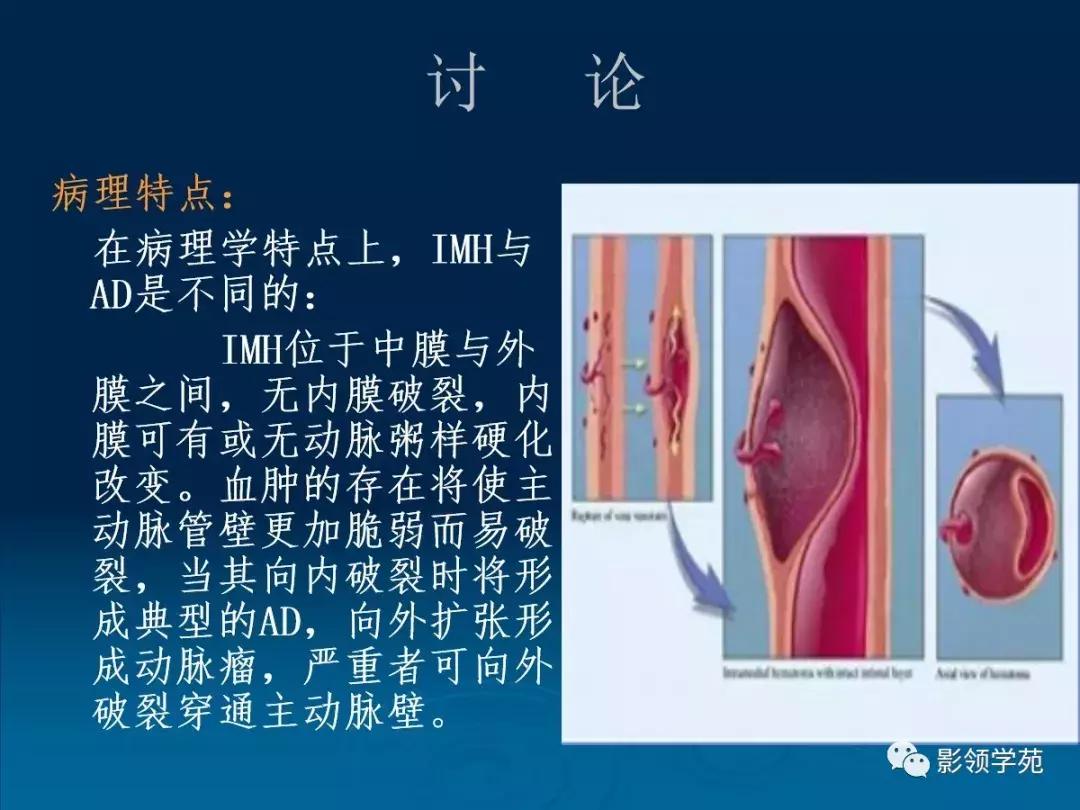主动脉壁间血肿护理查房,主动脉夹层和壁间血肿图片
