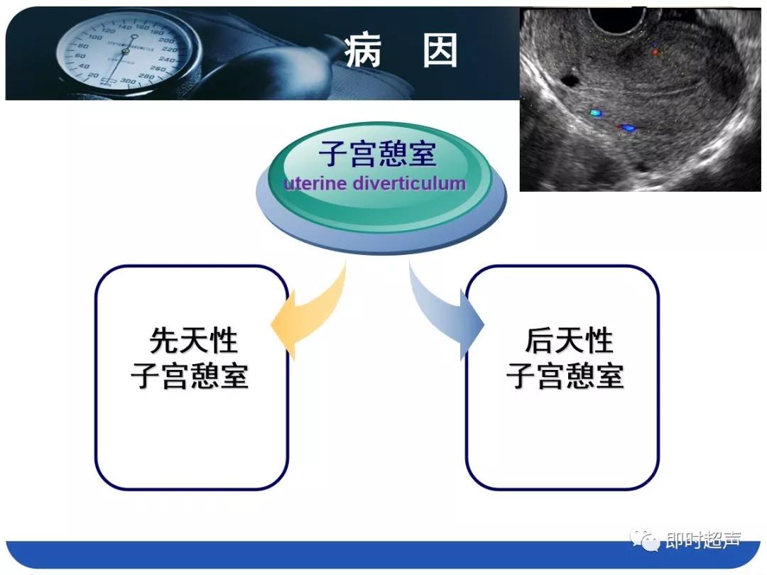 孕妇剖宫产瘢痕憩室,剖宫产瘢痕憩室息肉