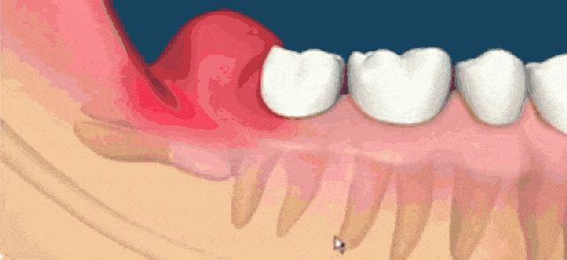 拔智齿断的一点在里面没有关系吗,拔智齿断了牙根留在里面如何处理