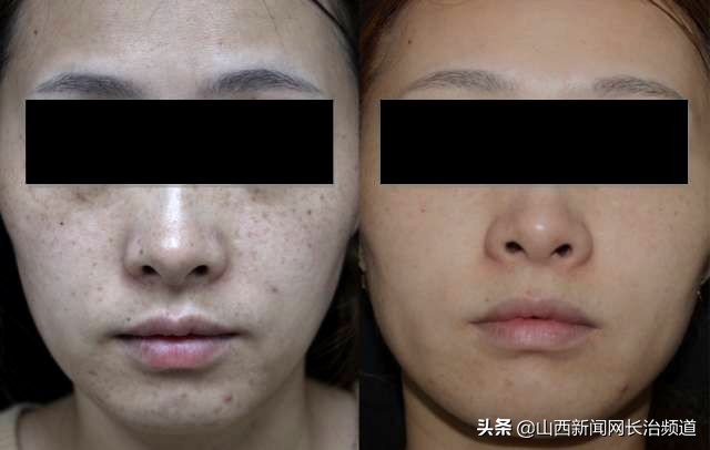 美肤激光祛疤全过程视频,美肤课堂推拿