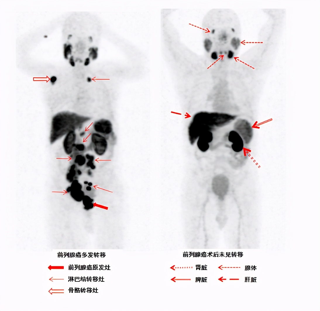 黑龙江省首例前列腺癌特异性新型示踪剂应用于临床18F-PSMA-1007PET/CT显像