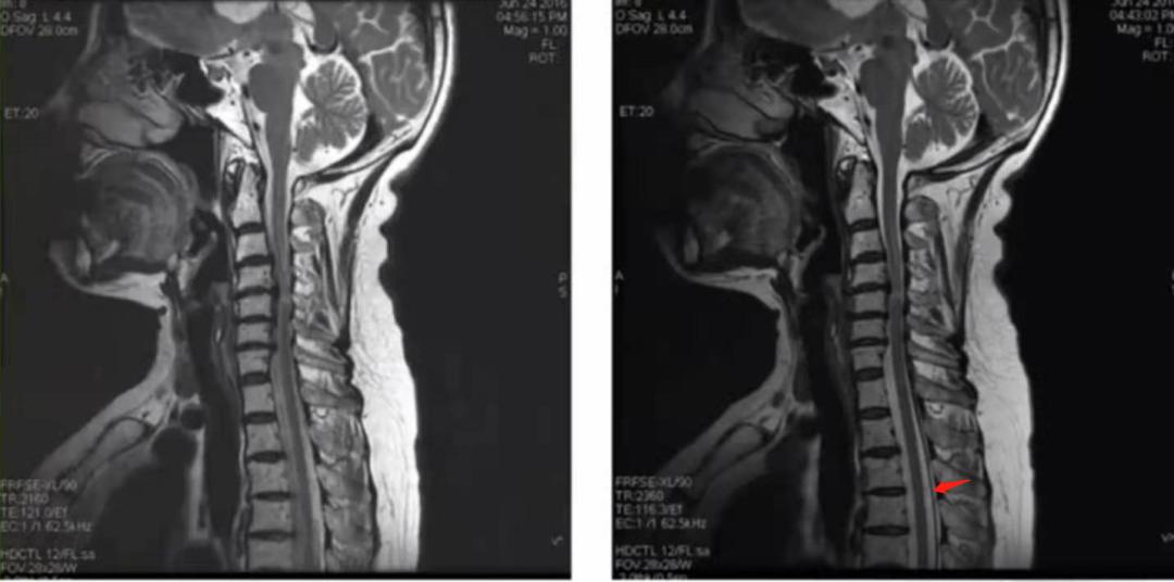 脊柱mr扫描规范,MR扫描各序列特点
