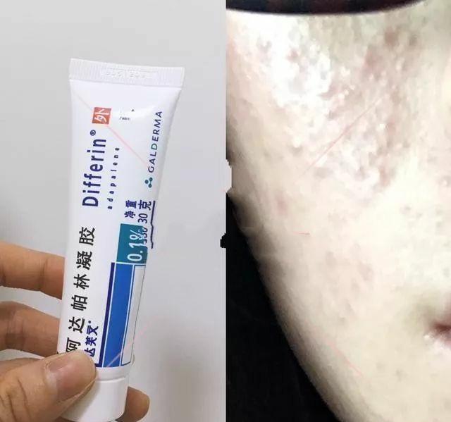 痘痘肌必备的消痘神器,秋冬战痘神器推荐