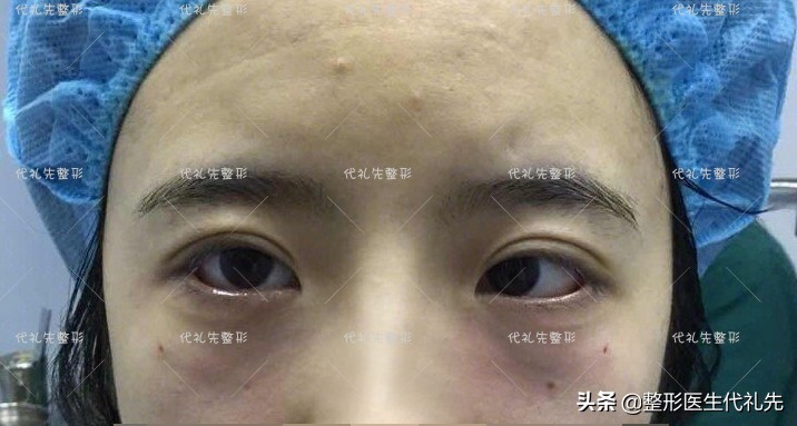 眼袋脂肪去除过多眼睛凹陷,做完眼袋下睑凹陷严重怎么办