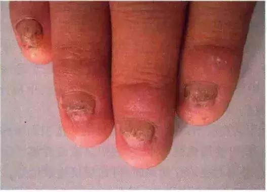 指甲有很小的黑色竖纹怎么回事,脚趾甲变黄变厚有竖纹是咋回事