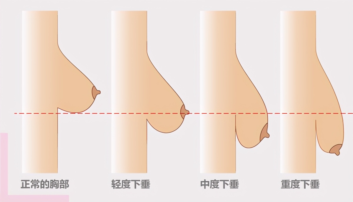 医美如何改善胸部下垂,乳房下垂改善的案例