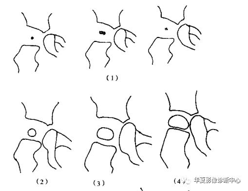 先天性髋关节脱位截骨术全过程,先天性髋关节脱位可以考驾驶证吗