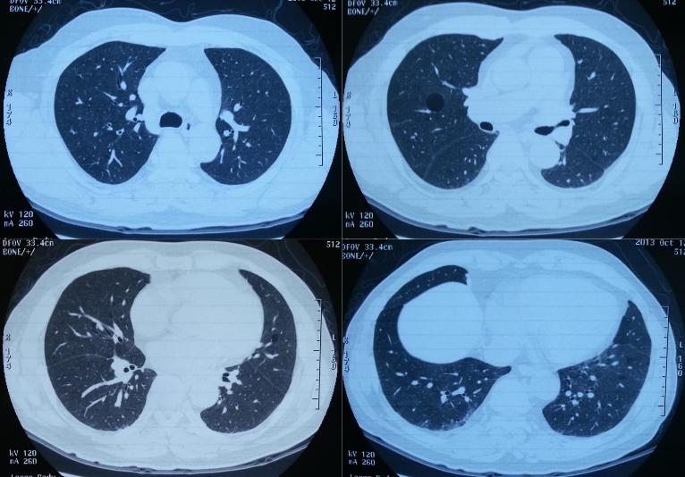 养鸽子造成皮肤真菌感染,养鸽子会得肺炎吗