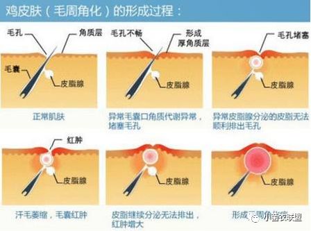 毛囊旁边长了小疙瘩不痛不痒,毛囊上肉疙瘩