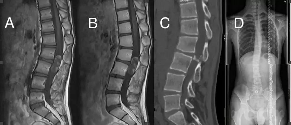 腰椎管内畸胎瘤能不能彻底治愈,腰椎管狭窄加脊柱侧弯怎么治疗