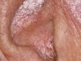 耳朵流脓要用滴耳液吗,耳朵流脓可以滴耳液么