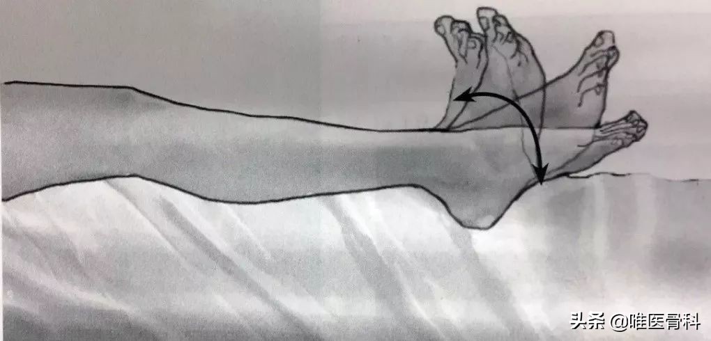 膝关节置换后血栓多长时间能消除,膝关节置换后血栓发病