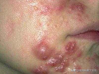 宅家的1个多月都没化妆，竟然还爆痘