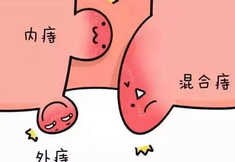 久坐为什么会得痔疮,人为什么会得痔疮和肛瘘