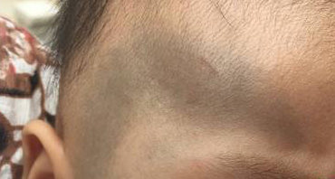 皮秒太田痣激光恢复过程,治疗太田痣费用贵吗