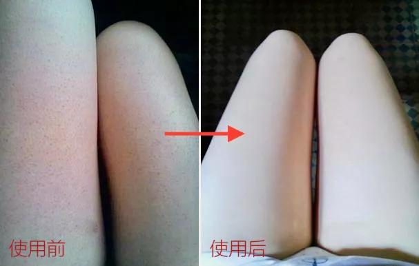 羊奶皂能去鸡皮肤吗,驴奶皂与羊奶皂哪个好