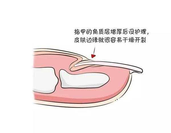手指甲起倒刺缺维生素什么,手指甲倒刺缺维生素