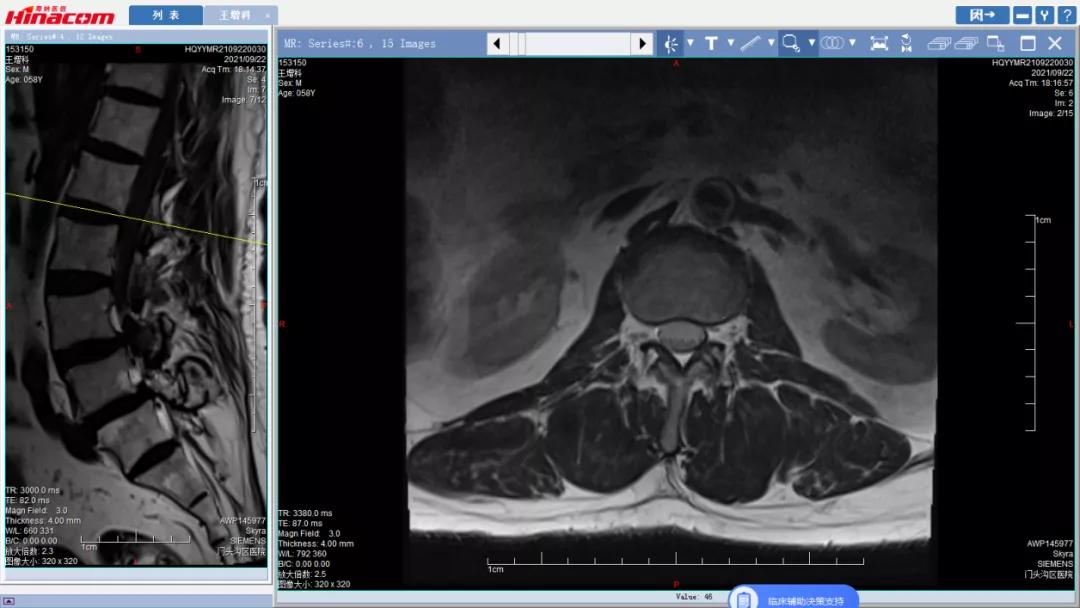 再也不用歪着身子走路了—区医院脊柱中心（骨二科）成功实施腰椎间盘摘除、椎间植骨融合钉棒内固定术
