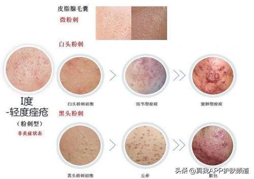 芦荟胶可以祛痘吗测评,芦荟胶祛痘的效果真的好吗