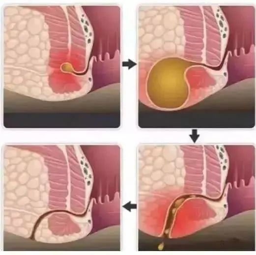 低位肛瘘手术多久能恢复,肛瘘手术治愈后还会重新患病吗