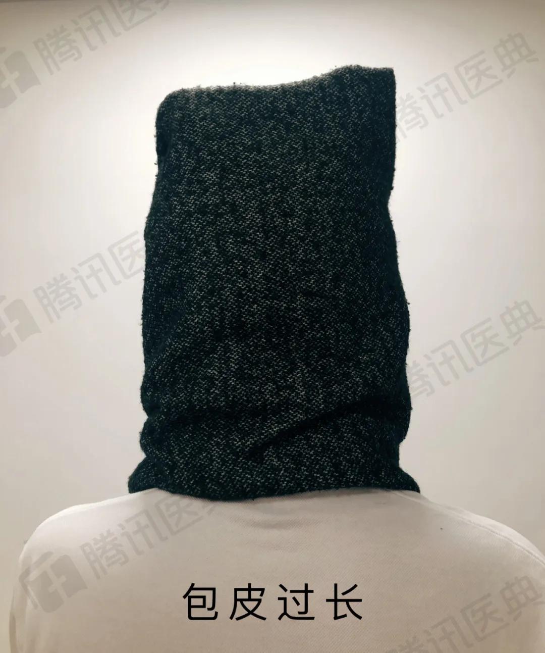 割包皮能解决系带短吗,割包皮能不能解决包皮嵌顿问题