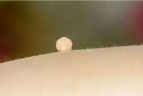 身上突然长了很多小肉疙瘩图片,身上突然长起小肉点会自己消除吗