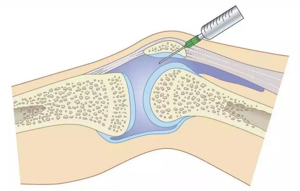 膝盖关节炎骨刺用什么药缓解疼痛,受冷膝盖长骨刺能治好吗
