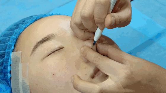 线雕隆鼻的问题,线雕隆鼻的后遗症多久出现