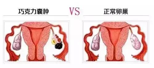 巧克力囊肿手术的利弊,巧克力囊肿的相关知识