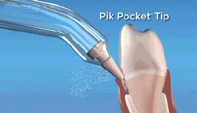 牙齿托槽正确处理方法,如何预防牙齿楔状磨损