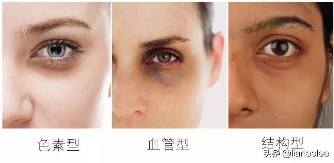 眼角皱纹最显老要注意防晒,眼角皱纹去皱最有效的方法