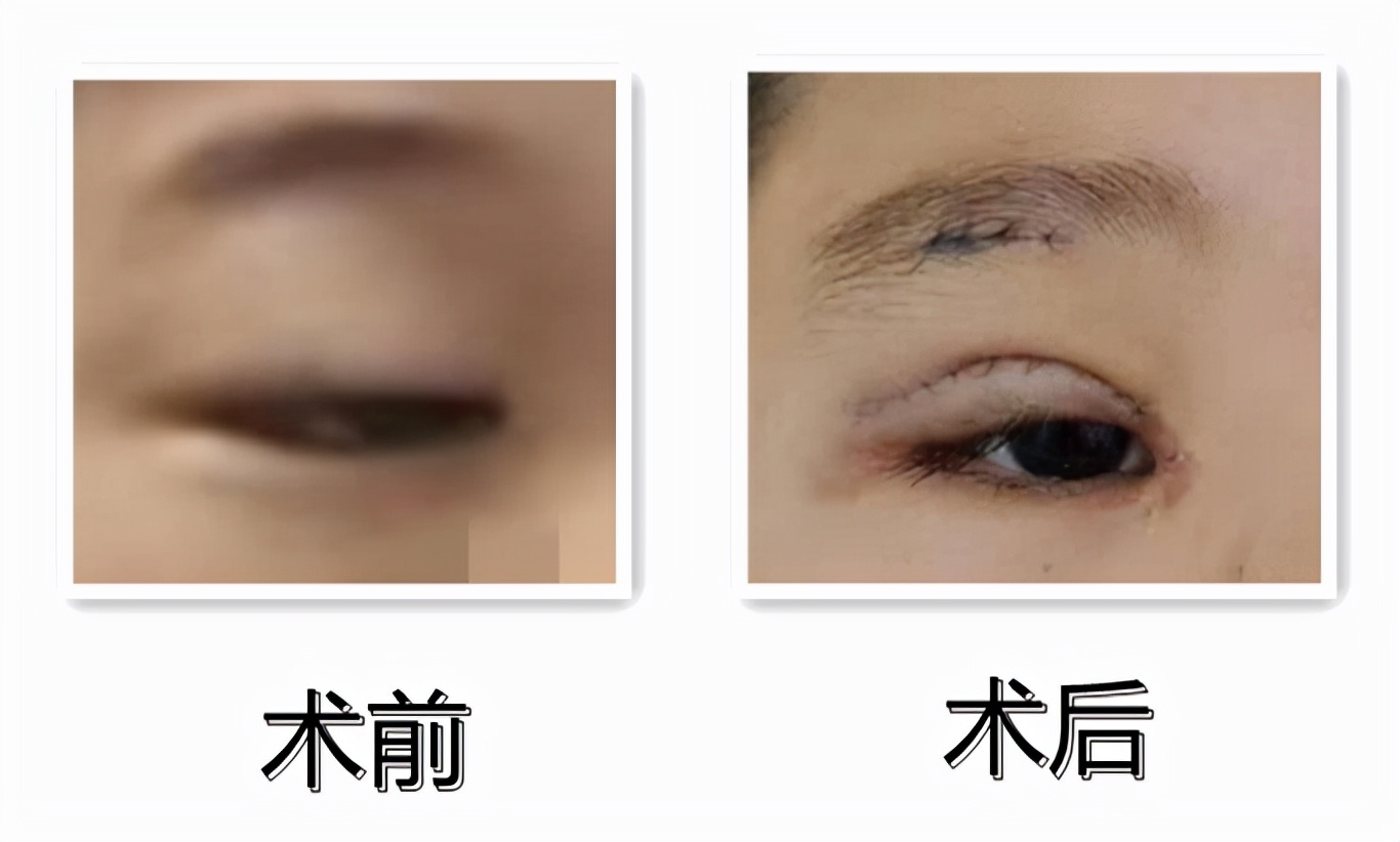 眼睛无神，总感觉睡不醒，警惕！可能是上睑下垂【呱呱教·164】