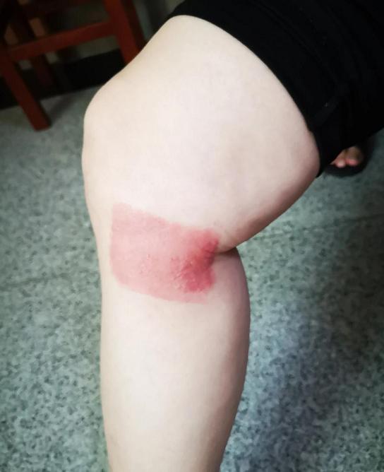 膝盖关节炎骨刺用什么药缓解疼痛,受冷膝盖长骨刺能治好吗