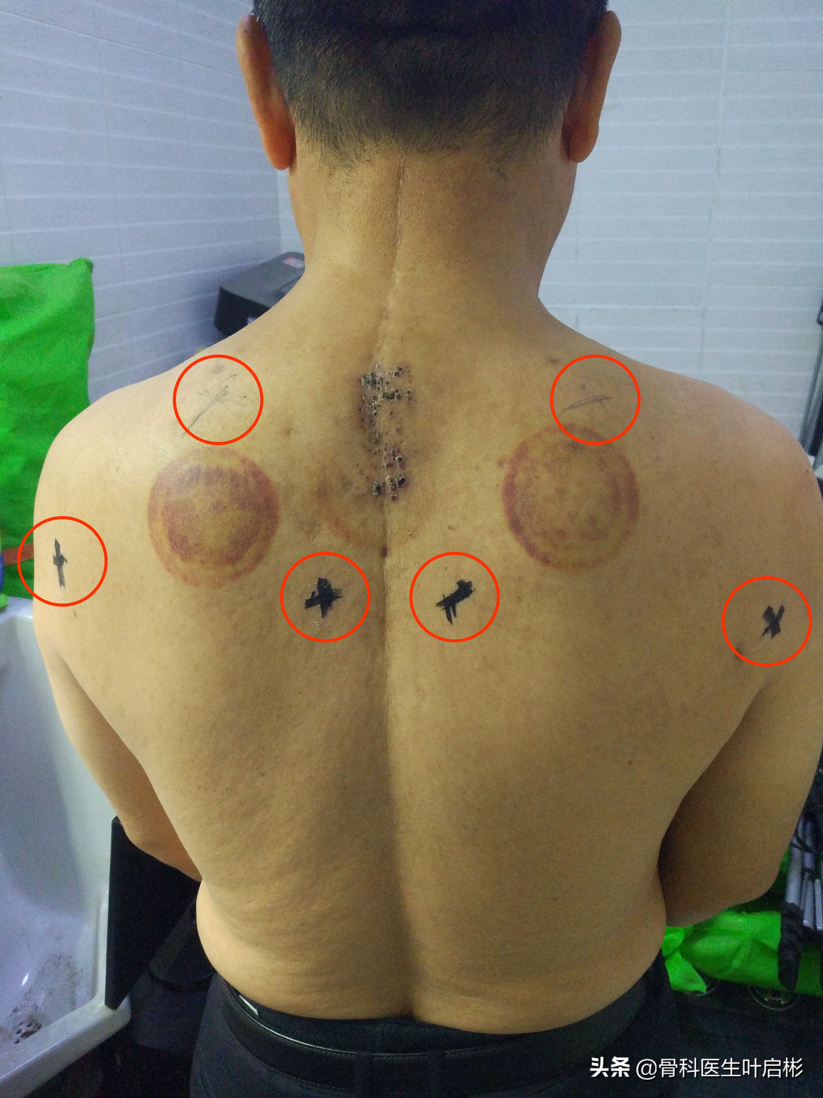 放血疗法很痛吗,肩膀痛放血流出血块