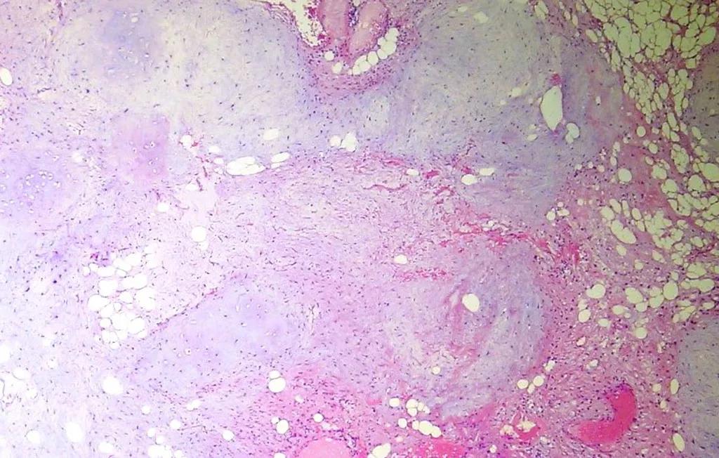 肺内见多发小囊状无纹理透光影,肺内肿块并厚壁空洞