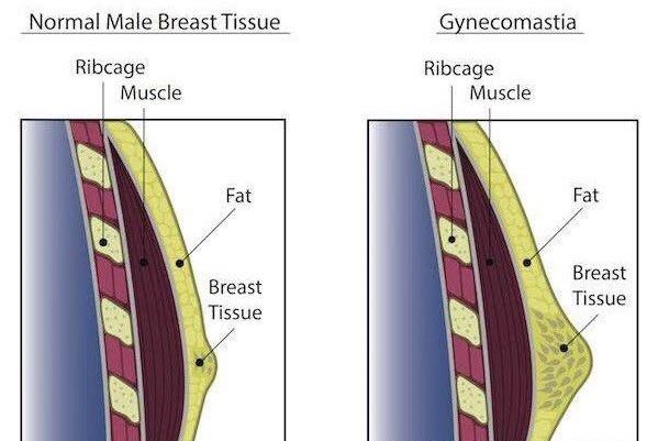 男性乳房发育太快怎么解决,二十岁男性乳房发育怎么治