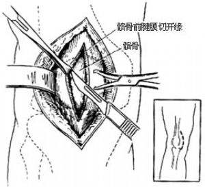膝盖打软是髌骨错位吗,膝盖髌骨软化酸胀三个月能锻炼吗