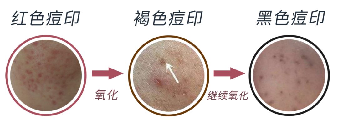 祛除痘印和痘疤的护肤品,正确的护肤方法帮你对抗顽固痘印