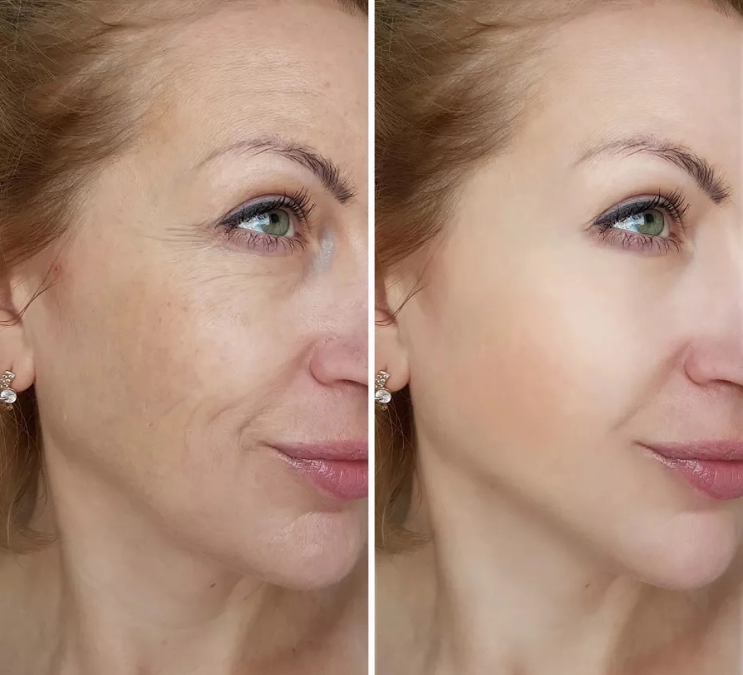 油性皮肤更抗衰老吗,油性皮肤保湿有用吗