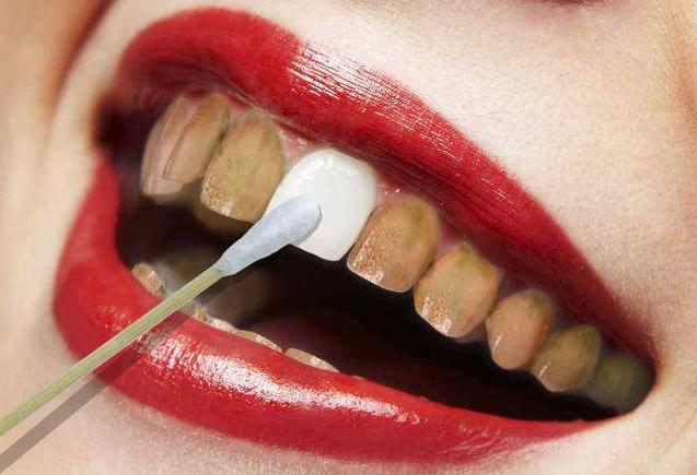 牙齿上的黄泥是什么,牙齿上的黄泥怎么去除