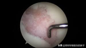 膝盖有骨刺应该注意些什么,膝盖骨刺正确处理办法