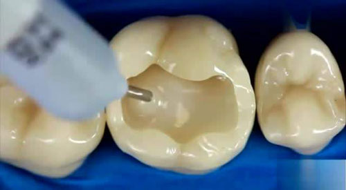 补牙有哪些流程,补牙以后需要注意什么