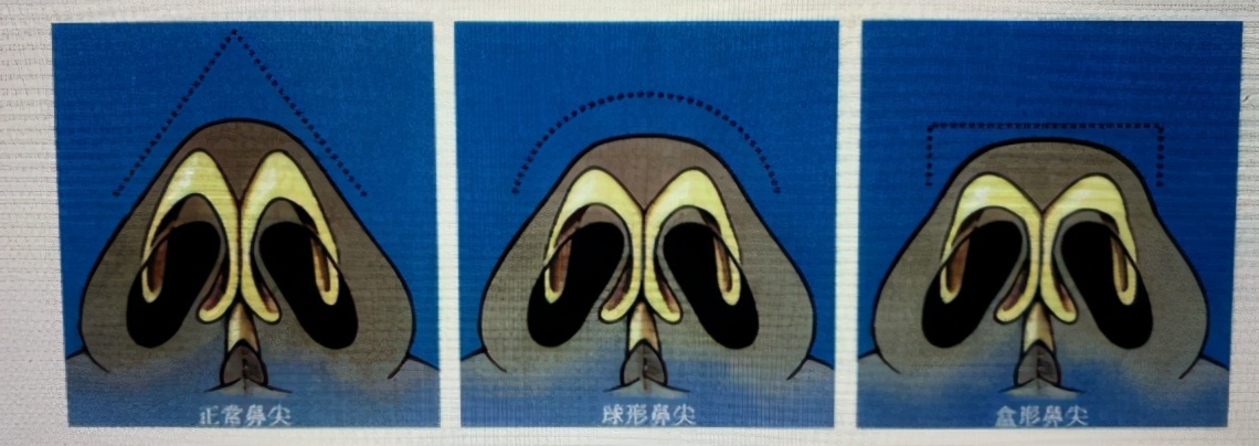 好看的鼻子类型驼峰鼻,好看的鼻型有哪几种